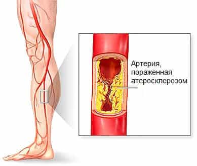 Атеросклероз артерий нижних конечностей