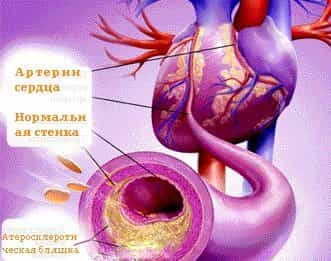 Атеросклероз коронарных артерий сердца 