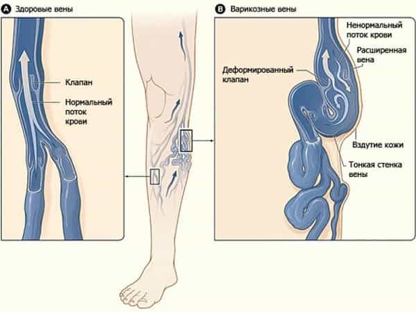 Варикозное расширение вен нижних конечностей