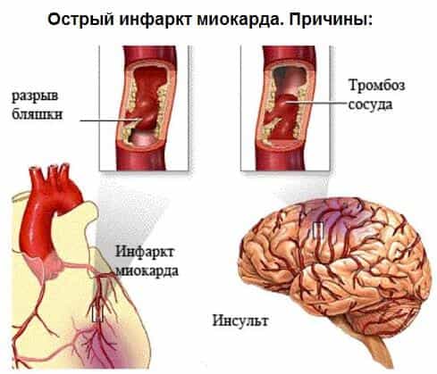 Инфаркт миокарда