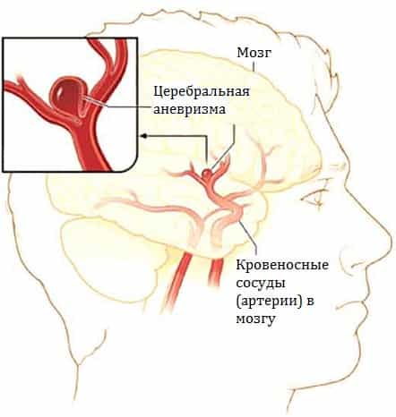 Венозная аневризма