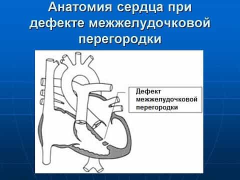 Дефект межжелудочковой перегородки