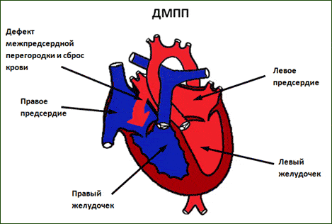 Дефект межпредсердной перегородки