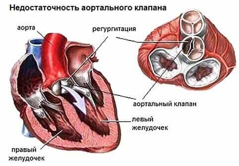 Незаращение артериального протока