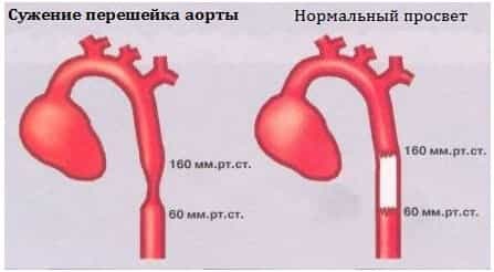 Сужение перешейка аорты