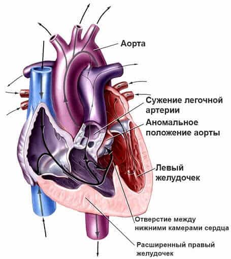 Тетрада Фалло