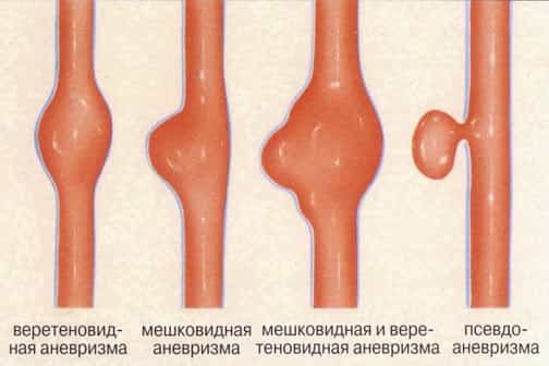 Виды аневризмы