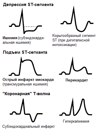 Симптомы инфаркта