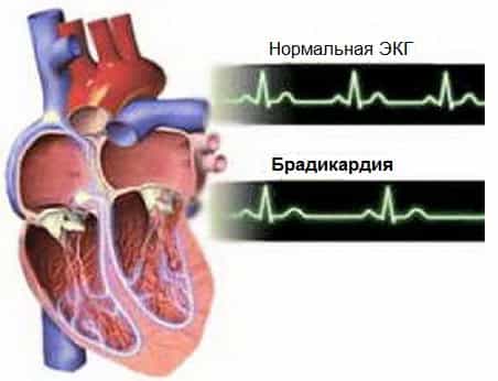 Брадикардия синусовая