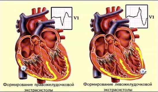 Экстрасистолы