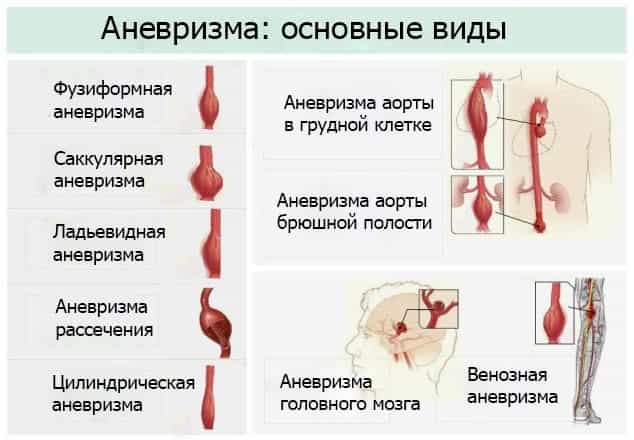 Виды аневризмы