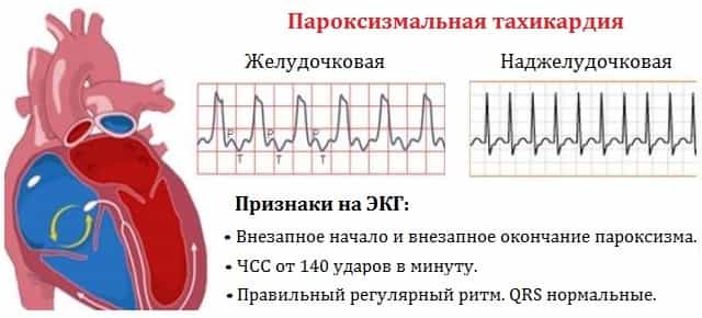 Пароксизмальная тахикардия фото
