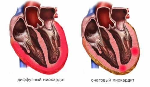 Миокардит 