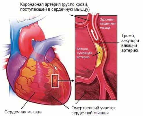 Ишемическая болезнь сердца