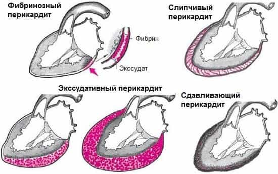 Перикардит