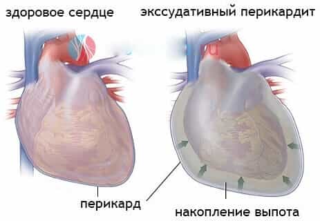 Экссудативный перикардит