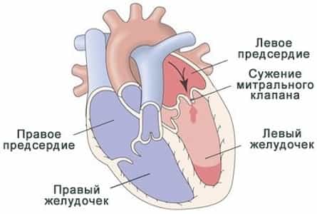 Митральный порок