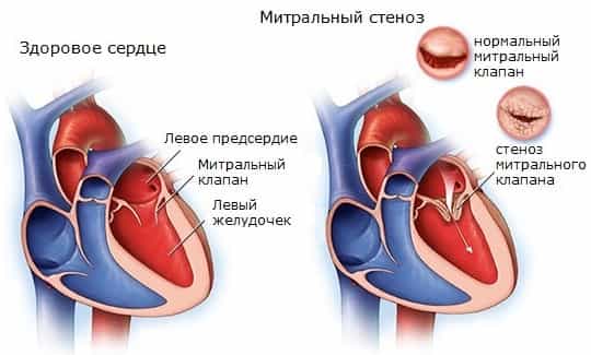 Митральный стеноз