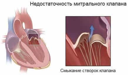 Недостаточность митрального клапана