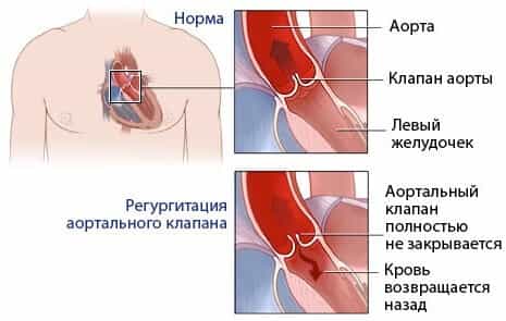 Аортальный порок