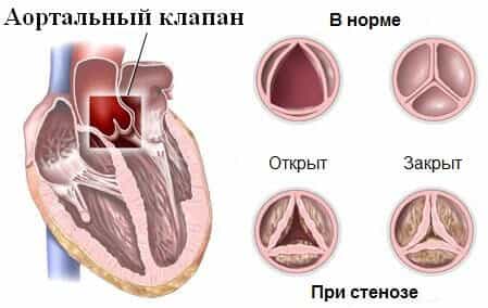 Аортальный стеноз