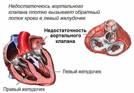 Недостаточность аортального клапана