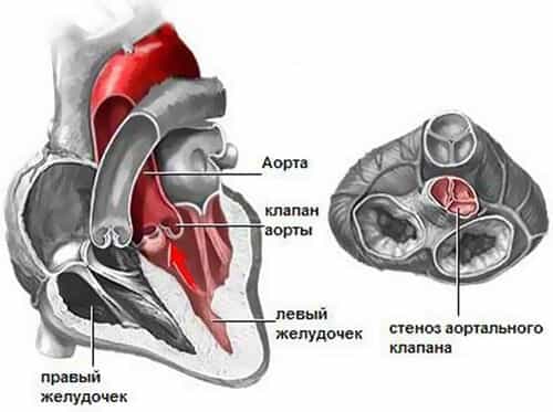 Комбинированный порок сердца