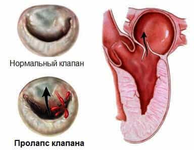 Пролапс митрального клапана