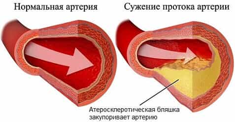 Атеросклероз коронарных артерий сердца