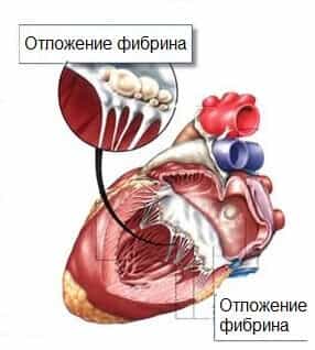 Ревматизм сердца