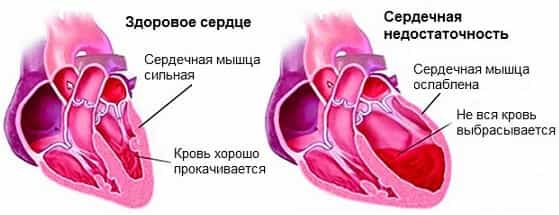 Сердечная недостаточность