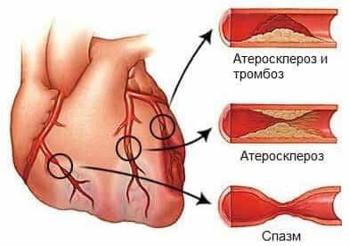 Давящая боль в груди