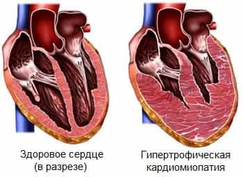 Кардиомиопатия