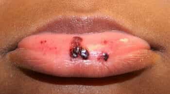 Идиопатическая тромбоцитопеническая пурпура (болезнь Верльгофа)