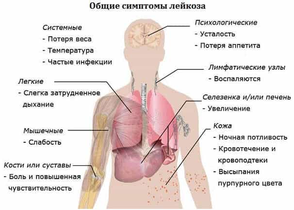 Острый лейкоз