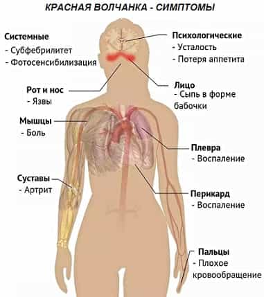 Системная красная волчанка