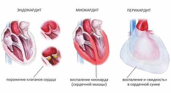 Миокардит