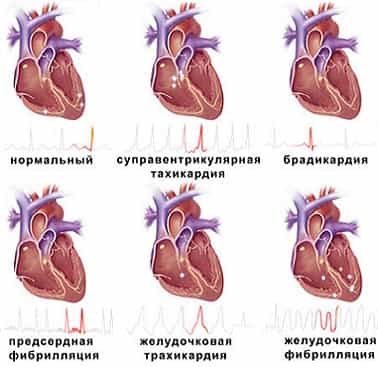 Нарушения ритма сердца