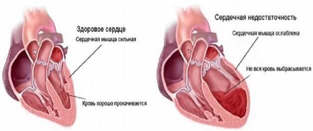 Сердечная недостаточность