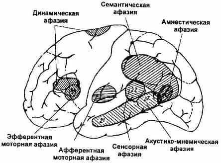 Виды афазий