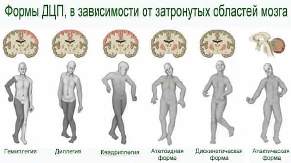 Детский церебральный паралич