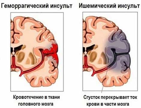 Виды инсульта