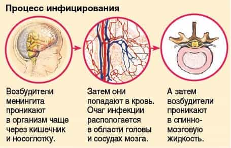 Менингит