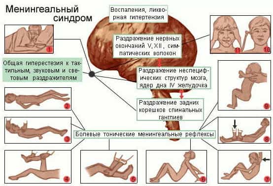 Менингеальный синдром