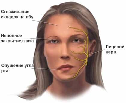 Лицевой нерв