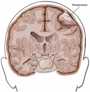 Опухоль головного мозга
