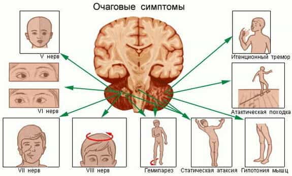 Симптомы опухоли головного мозга
