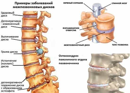 Остеохондроз