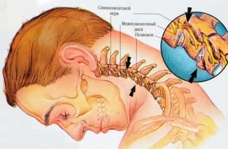 Защемление нерва