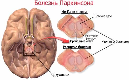 Болезнь Паркинсона